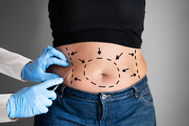 Cirurgia bariátrica: uma questão de saúde pública Cirurgia bariátrica: uma questão de saúde pública
